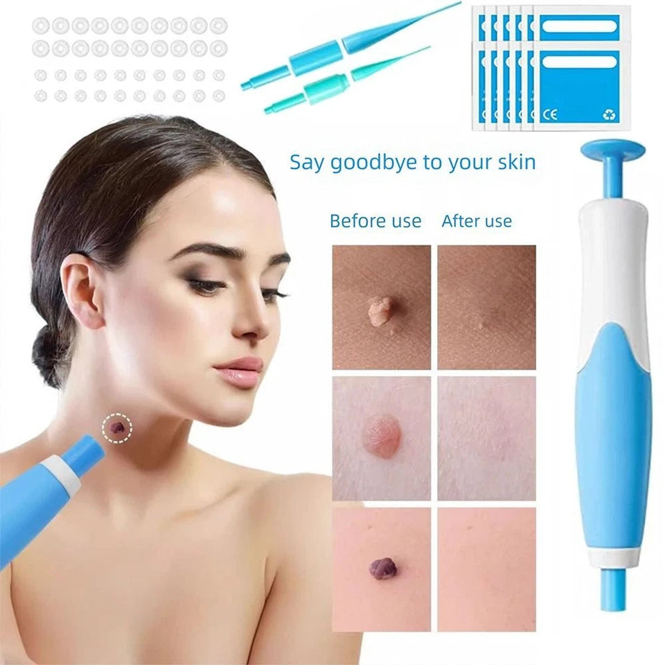Premium Skin Tag & Mole Remover – Safe, Painless & Effective Solution