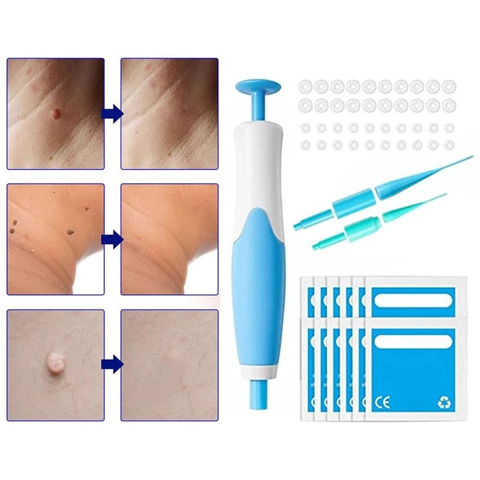 Premium Skin Tag & Mole Remover – Safe, Painless & Effective Solution